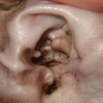 ácaros de oído