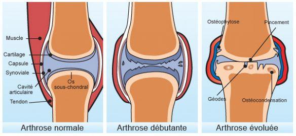 diagrama de osteoartritis